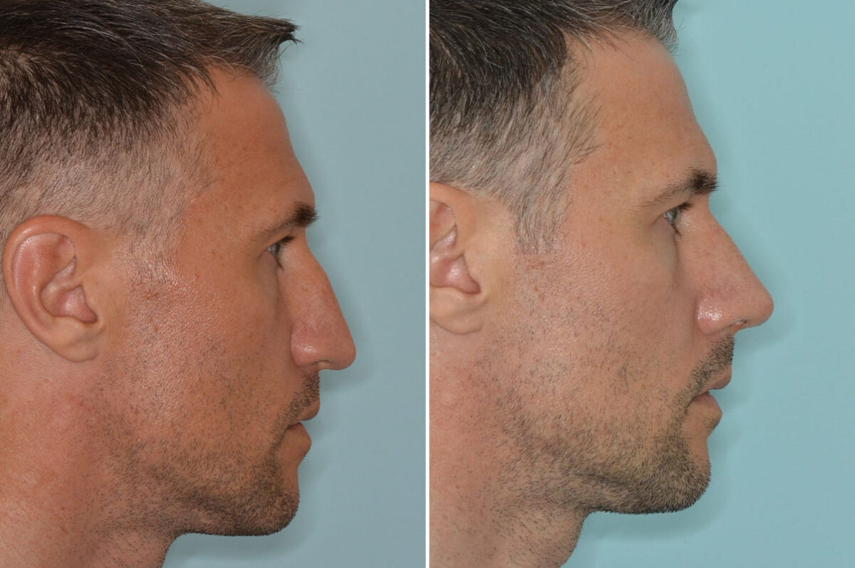 Rhinoplasty Before and After Photos in Miami, FL, Patient 8538