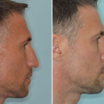 Rhinoplasty Before and After Photos in Miami, FL, Patient 8538