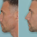 Rhinoplasty Before and After Photos in Miami, FL, Patient 8538