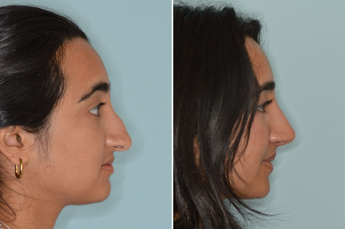 Rhinoplasty Before and After Photos in Miami, FL, Patient 8557