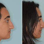 Rhinoplasty Before and After Photos in Miami, FL, Patient 8557