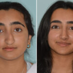 Rhinoplasty Before and After Photos in Miami, FL, Patient 8557