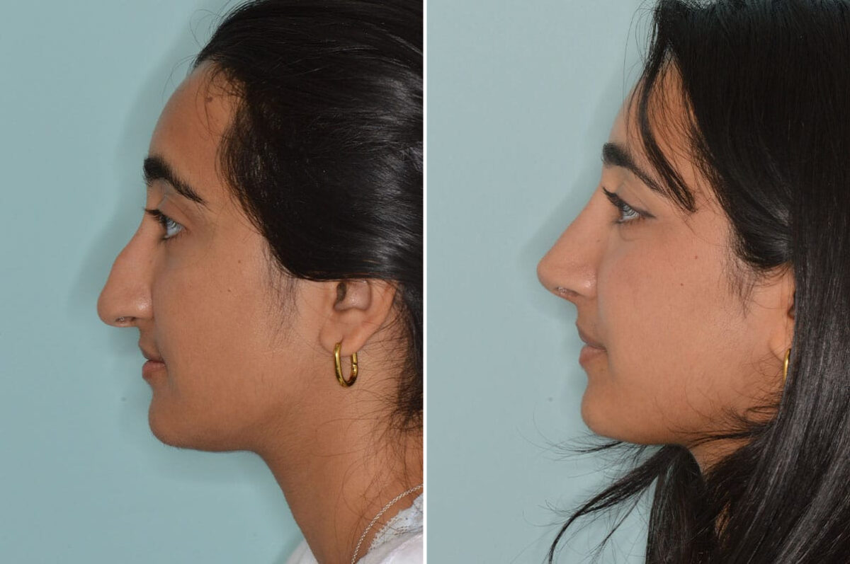 Rhinoplasty Before and After Photos in Miami, FL, Patient 8557