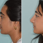 Rhinoplasty Before and After Photos in Miami, FL, Patient 8557