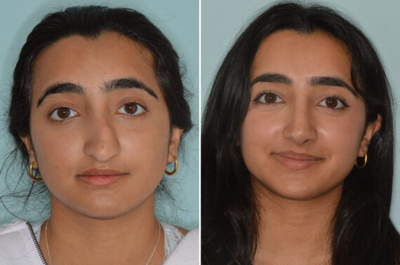Rhinoplasty Before and After Photos in Miami, FL, Patient 8557