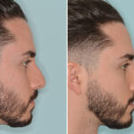 Rhinoplasty Before and After Photos in Miami, FL, Patient 8567