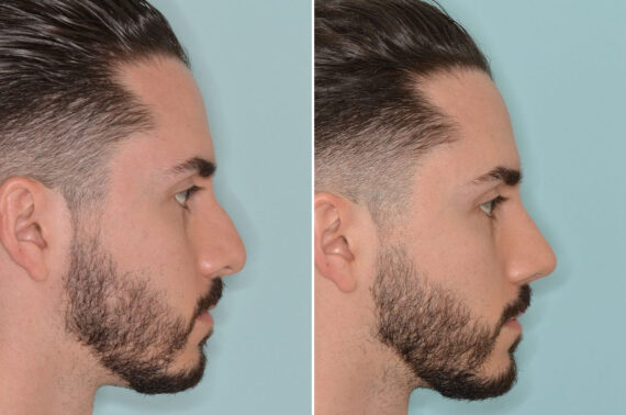 Rhinoplasty Before and After Photos in Miami, FL, Patient 8567