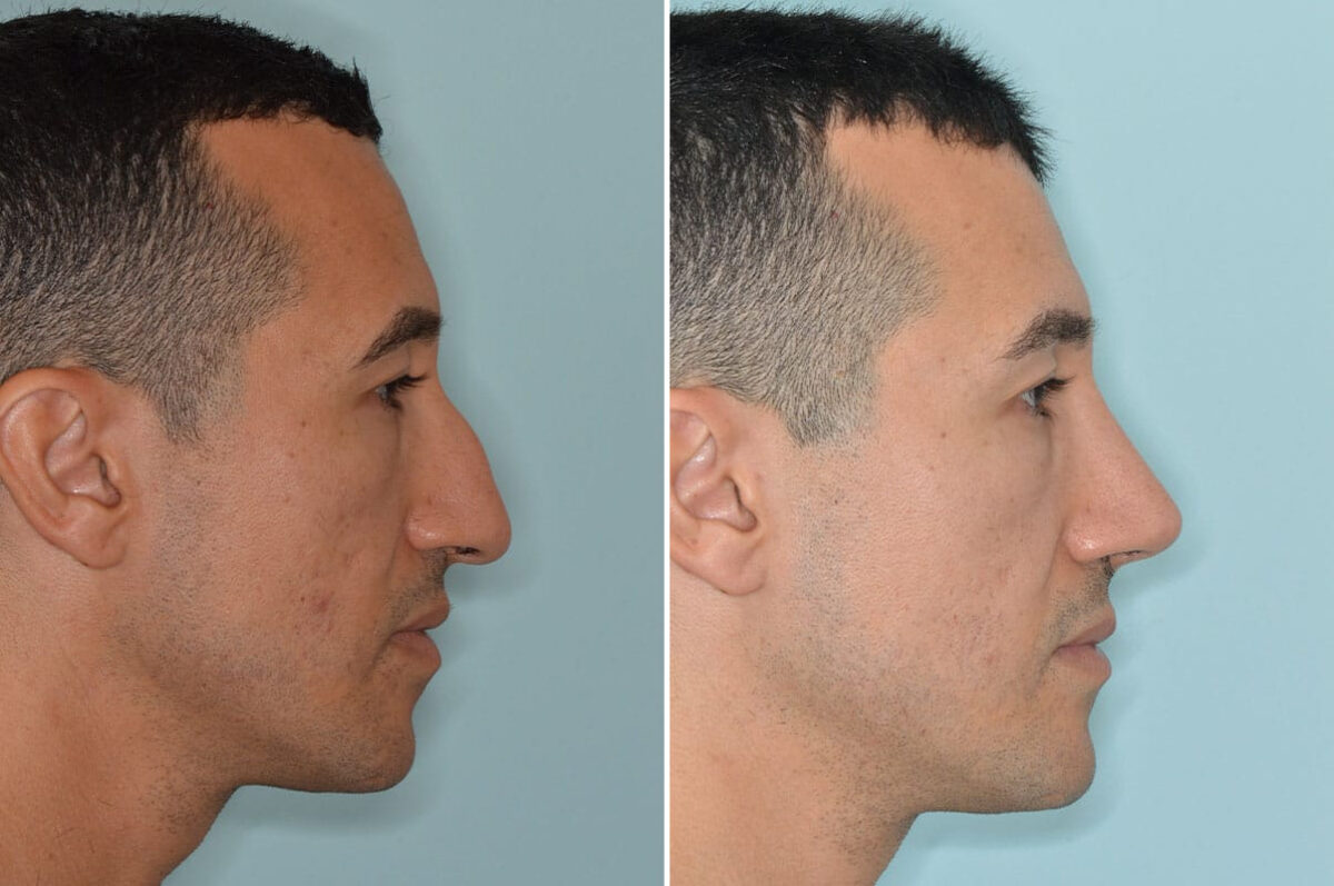 Rhinoplasty Before and After Photos in Miami, FL, Patient 8571
