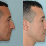 Rhinoplasty Before and After Photos in Miami, FL, Patient 8571