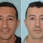 Rhinoplasty Before and After Photos in Miami, FL, Patient 8571