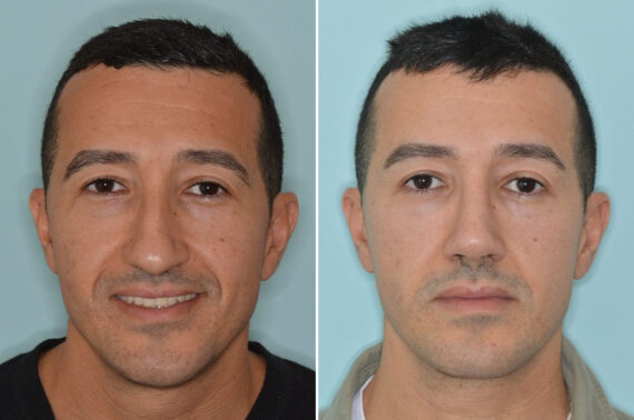 Rhinoplasty Before and After Photos in Miami, FL, Patient 8571