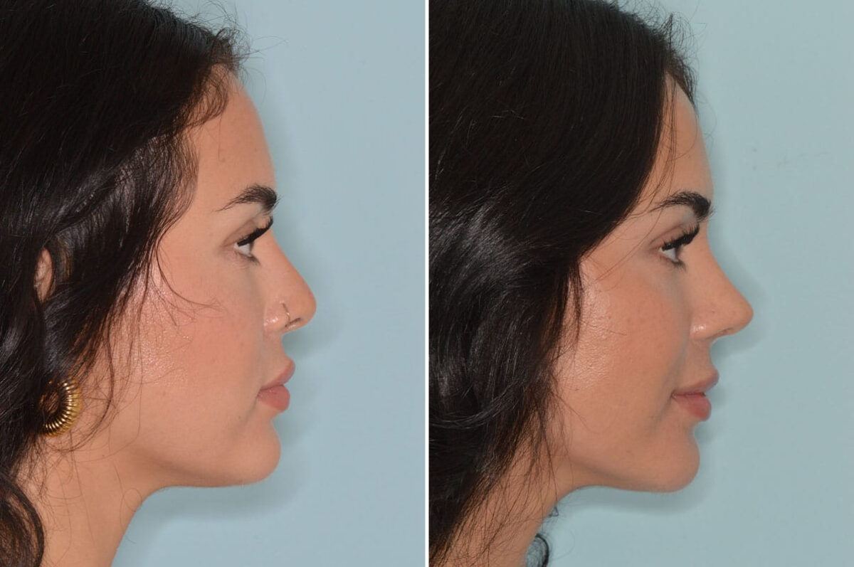 Rhinoplasty Before and After Photos in Miami, FL, Patient 8744