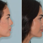Rhinoplasty Before and After Photos in Miami, FL, Patient 8744