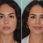 Rhinoplasty Before and After Photos in Miami, FL, Patient 8744