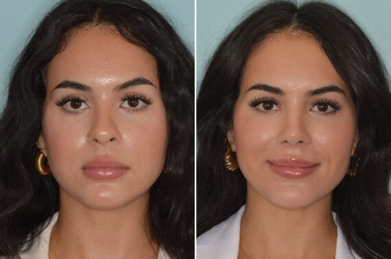 Rhinoplasty Before and After Photos in Miami, FL, Patient 8744