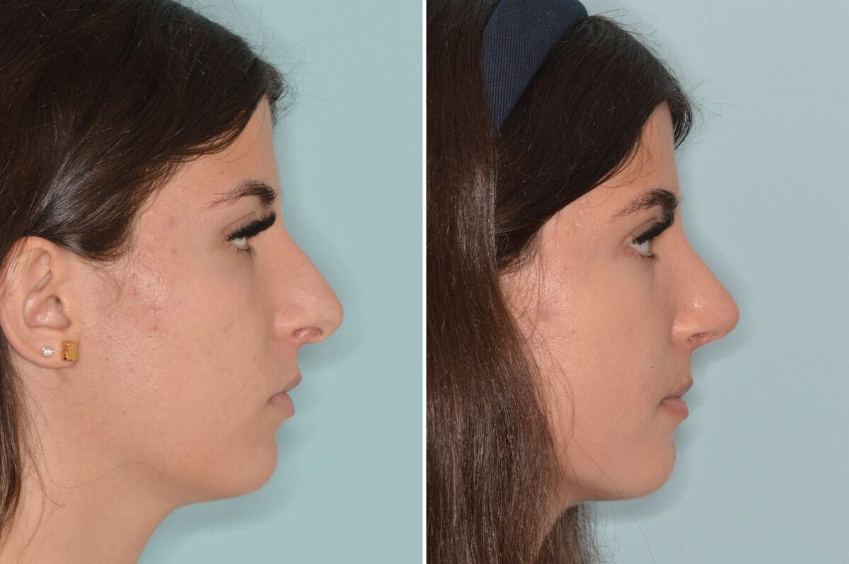 Rhinoplasty Before and After Photos in Miami, FL, Patient 8751