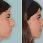 Rhinoplasty Before and After Photos in Miami, FL, Patient 8751