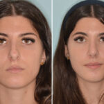 Rhinoplasty Before and After Photos in Miami, FL, Patient 8751