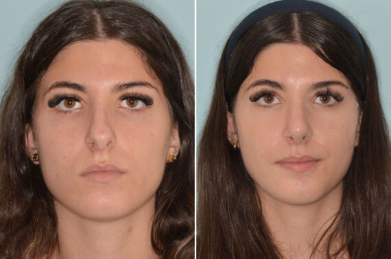 Rhinoplasty Before and After Photos in Miami, FL, Patient 8751