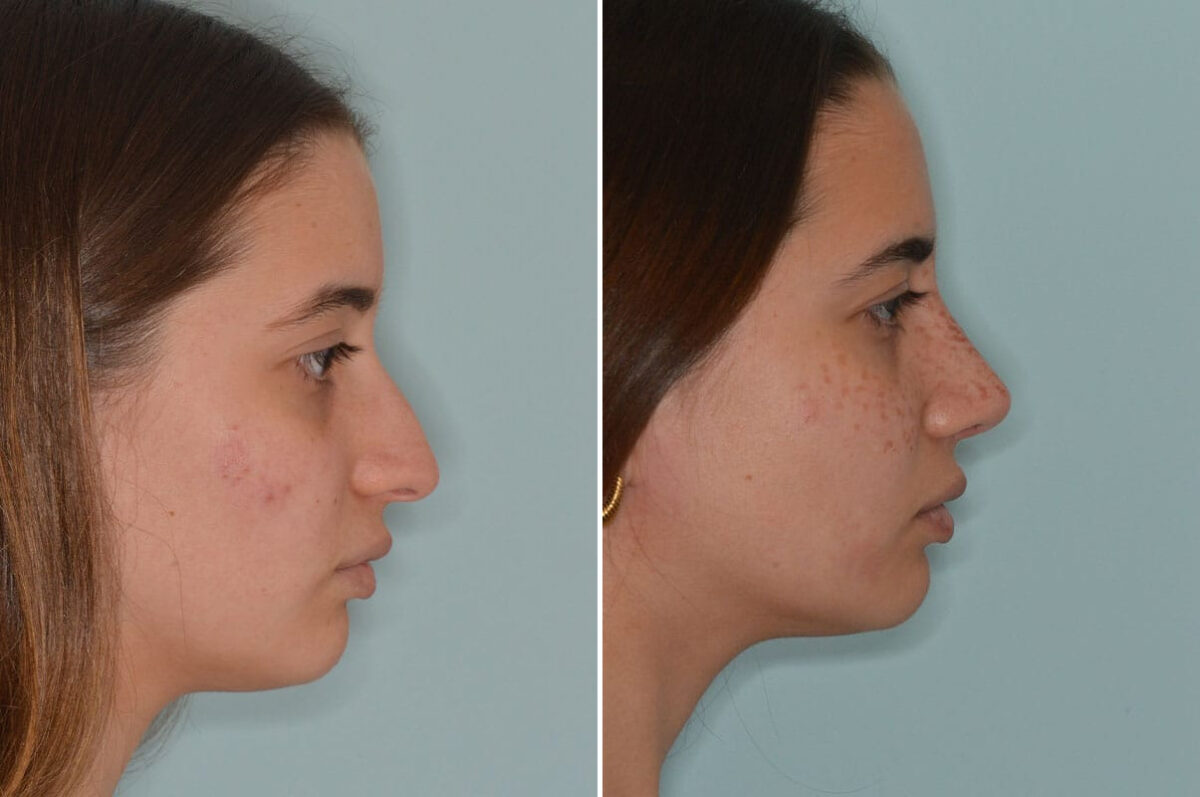 Rhinoplasty Before and After Photos in Miami, FL, Patient 8758