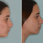Rhinoplasty Before and After Photos in Miami, FL, Patient 8758