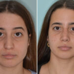 Rhinoplasty Before and After Photos in Miami, FL, Patient 8758