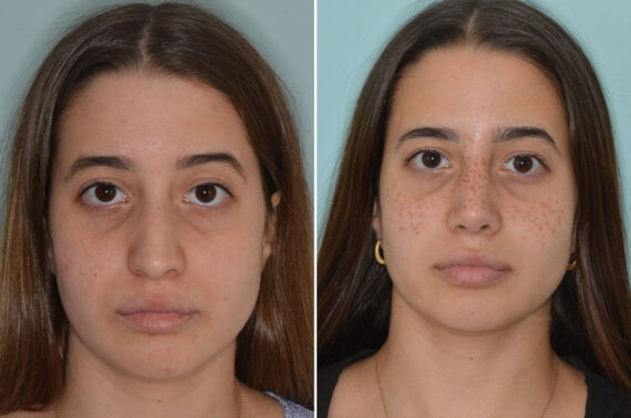 Rhinoplasty Before and After Photos in Miami, FL, Patient 8758