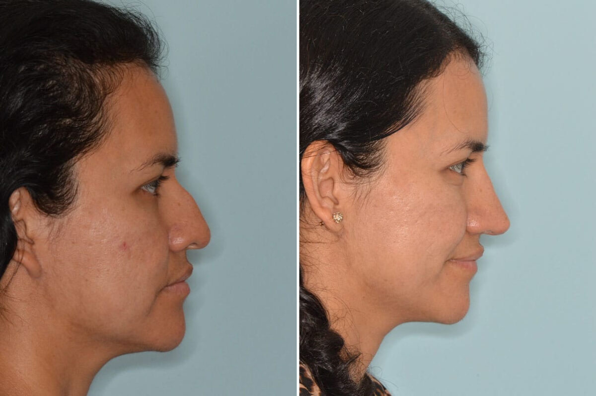 Rhinoplasty Before and After Photos in Miami, FL, Patient 8765