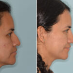 Rhinoplasty Before and After Photos in Miami, FL, Patient 8765
