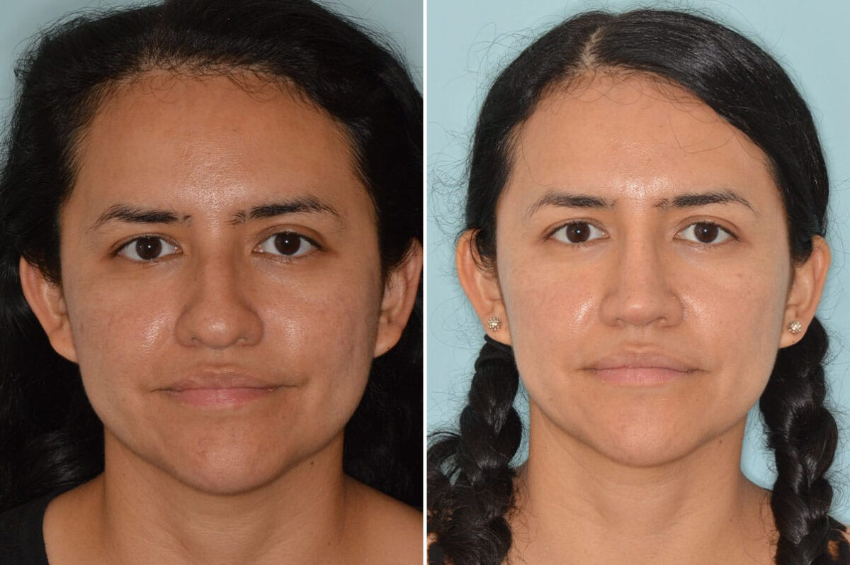 Rhinoplasty Before and After Photos in Miami, FL, Patient 8765