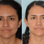 Rhinoplasty Before and After Photos in Miami, FL, Patient 8765