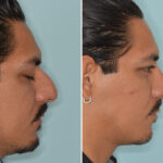 Rhinoplasty Before and After Photos in Miami, FL, Patient 8772