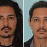 Rhinoplasty Before and After Photos in Miami, FL, Patient 8772