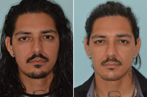 Rhinoplasty Before and After Photos in Miami, FL, Patient 8772