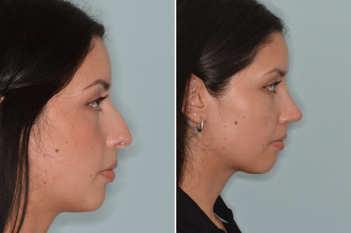Rhinoplasty Before and After Photos in Miami, FL, Patient 8782