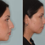Rhinoplasty Before and After Photos in Miami, FL, Patient 8782