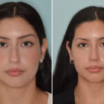 Rhinoplasty Before and After Photos in Miami, FL, Patient 8782