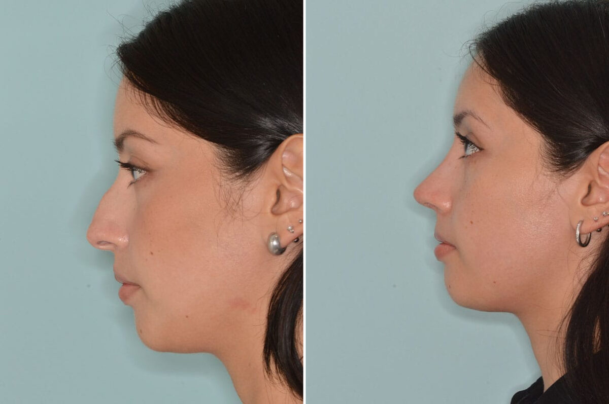 Rhinoplasty Before and After Photos in Miami, FL, Patient 8782