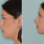 Rhinoplasty Before and After Photos in Miami, FL, Patient 8782