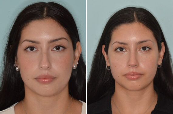 Rhinoplasty Before and After Photos in Miami, FL, Patient 8782