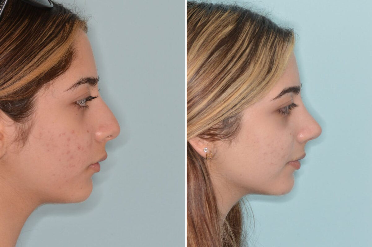 Ethnic Rhinoplasty Before and After Photos in Miami, FL, Patient 8792