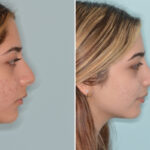 Ethnic Rhinoplasty Before and After Photos in Miami, FL, Patient 8792