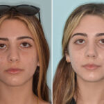 Ethnic Rhinoplasty Before and After Photos in Miami, FL, Patient 8792