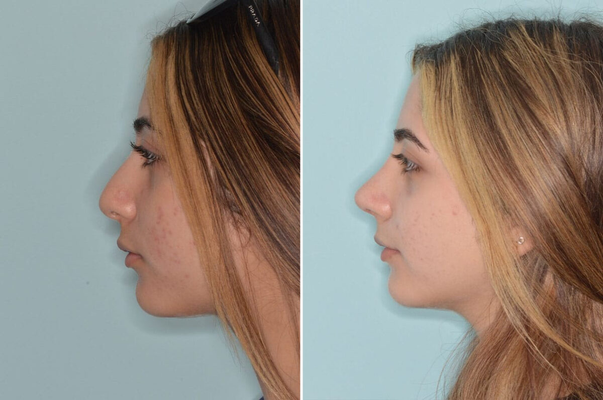 Ethnic Rhinoplasty Before and After Photos in Miami, FL, Patient 8792