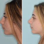 Ethnic Rhinoplasty Before and After Photos in Miami, FL, Patient 8792