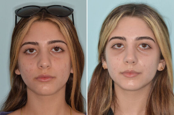 Ethnic Rhinoplasty Before and After Photos in Miami, FL, Patient 8792