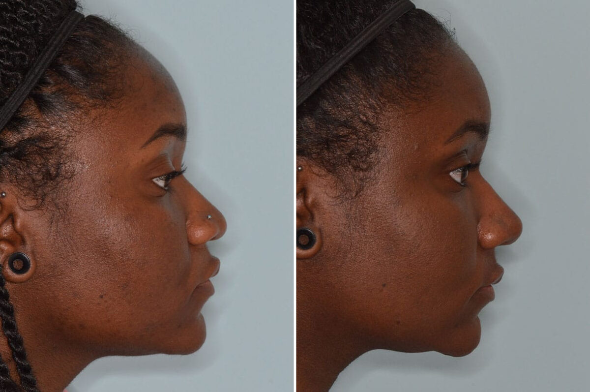 Ethnic Rhinoplasty Before and After Photos in Miami, FL, Patient 8802
