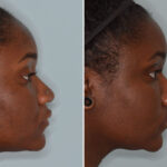 Ethnic Rhinoplasty Before and After Photos in Miami, FL, Patient 8802