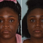 Ethnic Rhinoplasty Before and After Photos in Miami, FL, Patient 8802