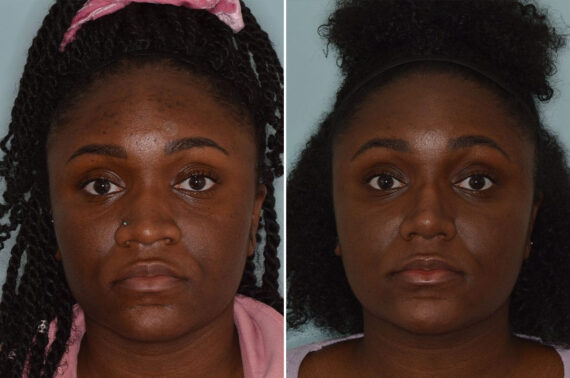 Ethnic Rhinoplasty Before and After Photos in Miami, FL, Patient 8802